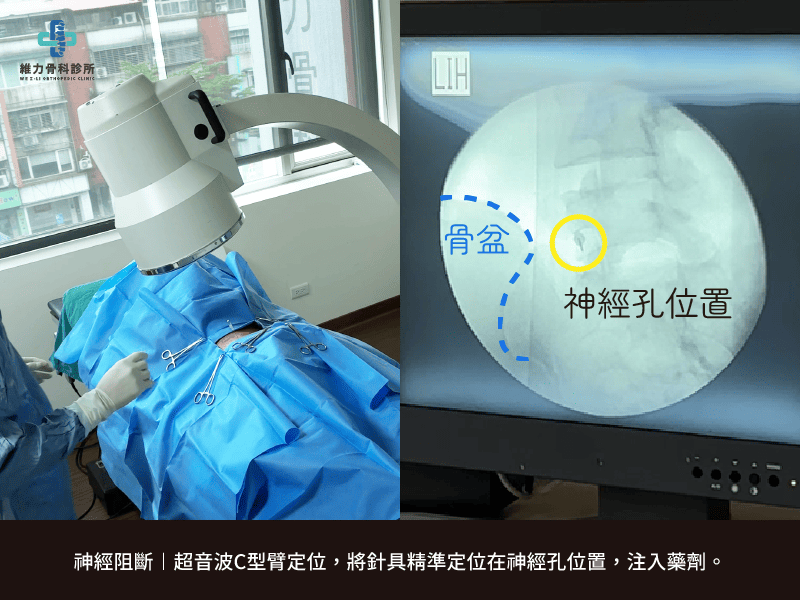 進行腰椎神經阻斷手術