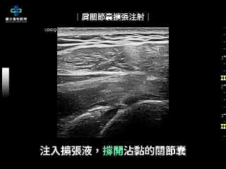 肩關節囊擴張注射超音波變化