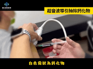 超音波導引抽鈣化影片