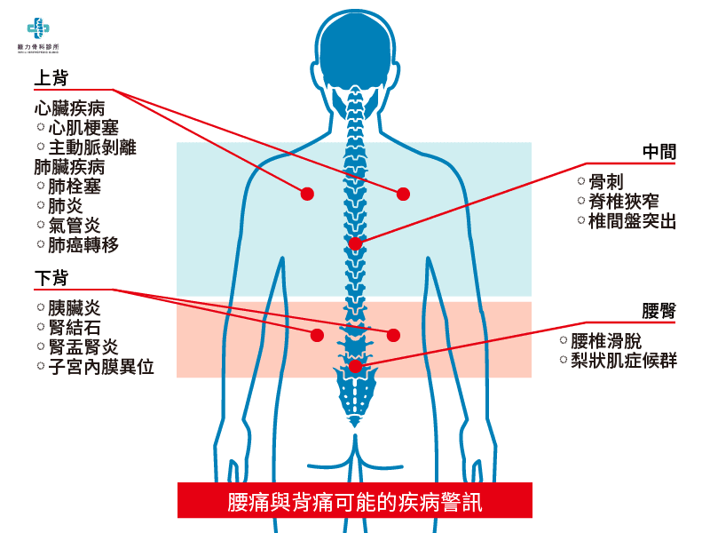 腰痛背痛的疾病警訊