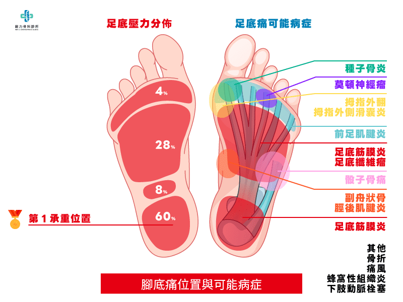 腳底痛位置與可能疾病