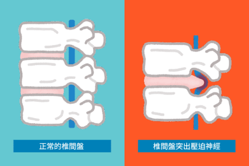 椎間盤突出