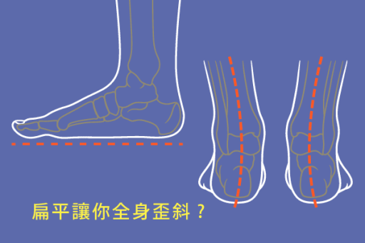 扁平足