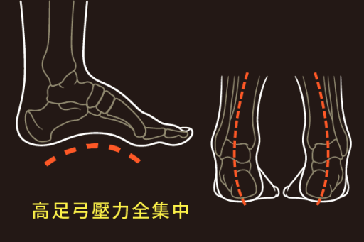 高足弓