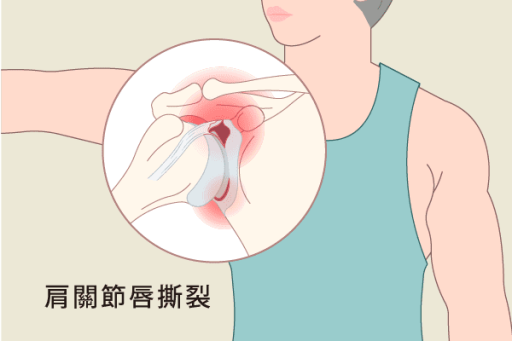 肩關節唇撕裂