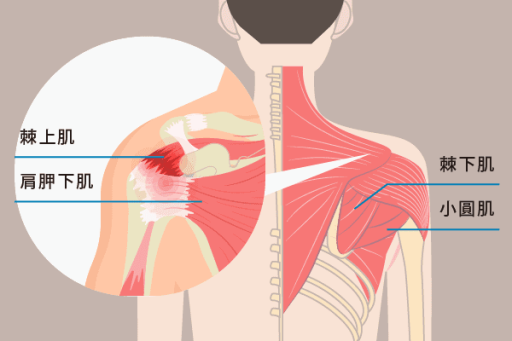 旋轉肌袖症候群