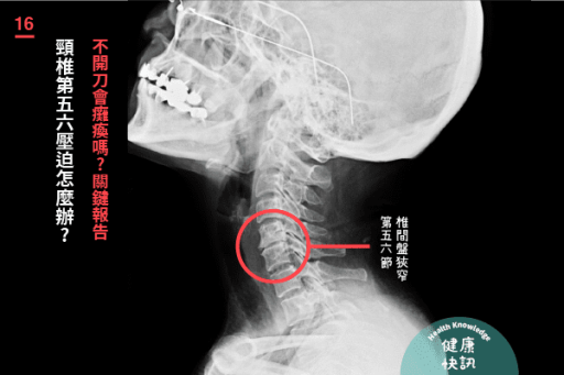 頸椎第五六節壓迫