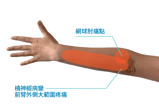 橈神經病變與網球肘的差別
