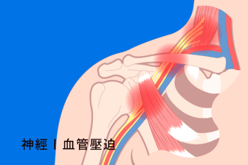 胸廓出口症候群