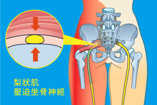 梨狀肌症候群