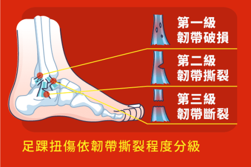 足踝扭傷