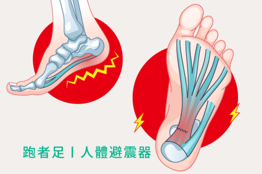 足底筋膜炎
