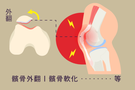 髕骨股骨症候群