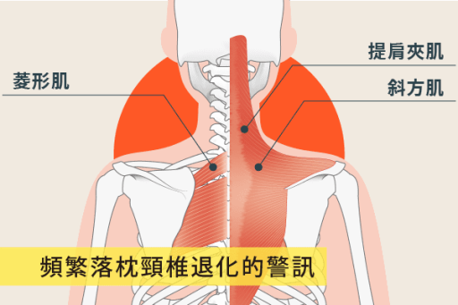 落枕頸椎急性關節周圍炎