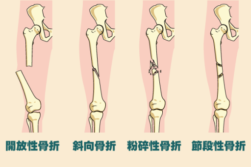 骨折