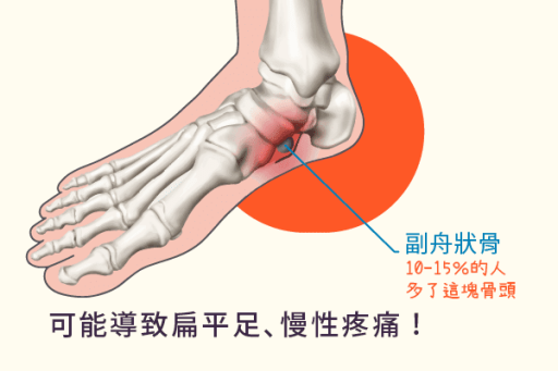 副舟状骨症候群