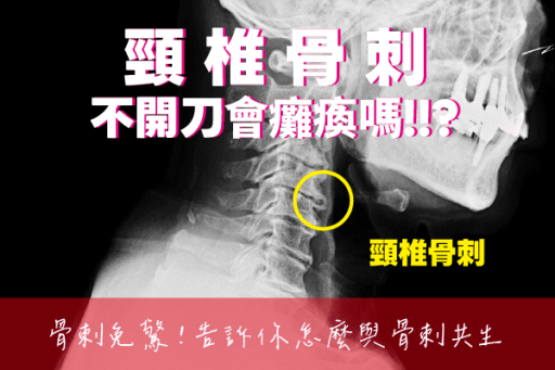 頸椎骨刺
