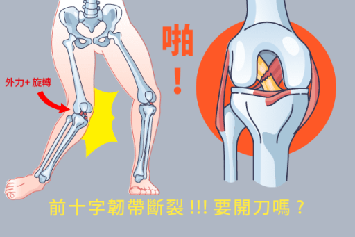 前十字韌帶損傷