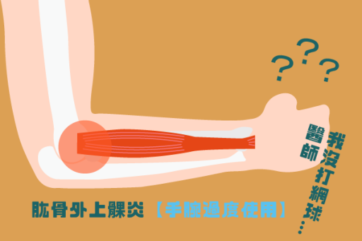 什麼是網球肘