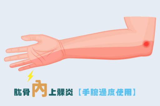 手肘痛內側手肘無力高爾夫球肘怎麼辦