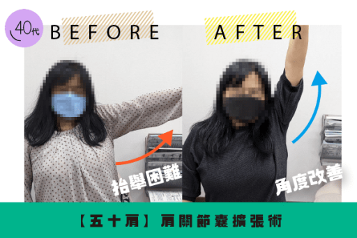 6個月肩膀痛，肩關節擴張術改善肩膀角度