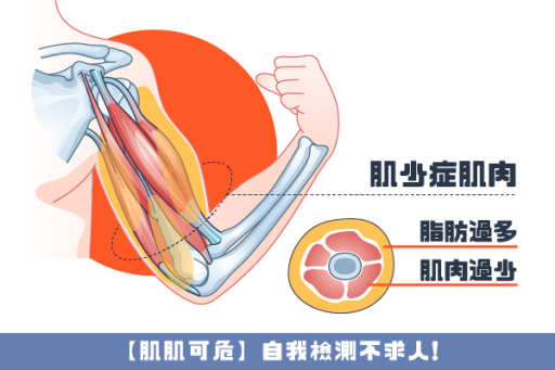 經常跌倒、腳無力，我有肌少症嗎？