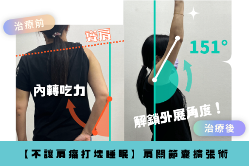 不再干擾睡眠，肩關節擴張術恢復肩膀靈活力