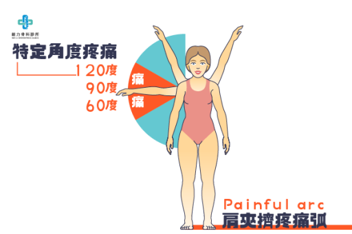 肩夾擠疼痛弧