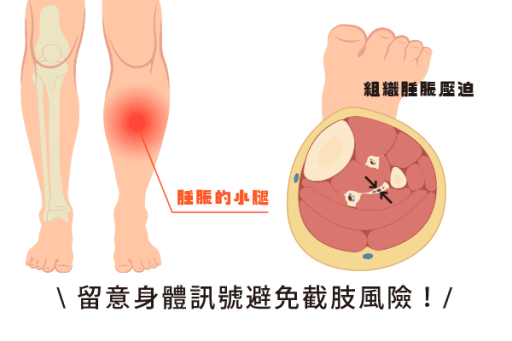 急性腔室症候群