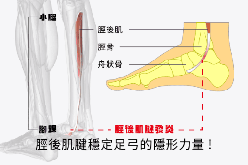 脛後肌鍵炎怎麼辦