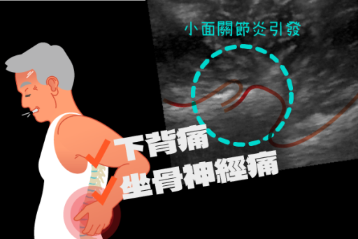 下背痛、坐骨神經痛，PRP注射