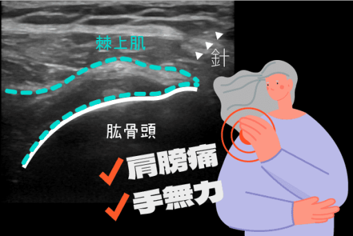 肩膀痛、手無力，棘上肌扭傷