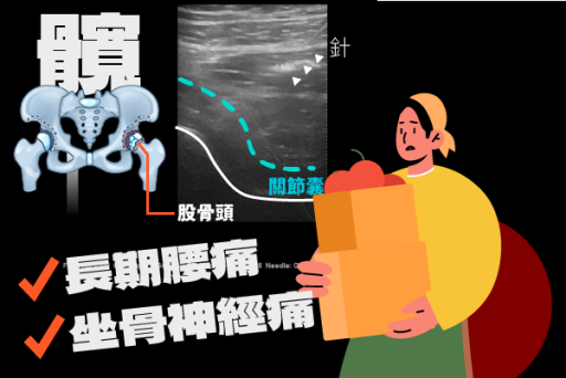 髖關節扭傷玻尿酸注射