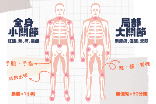 類風濕性關節炎