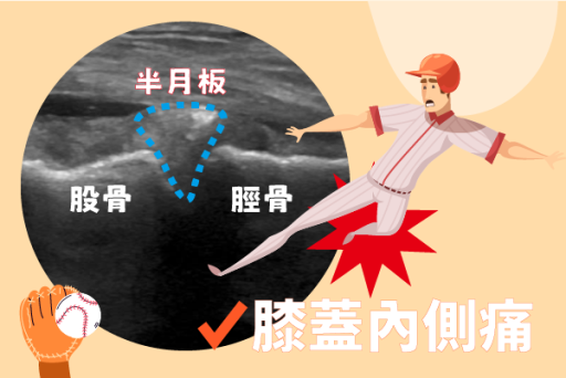 膝關節內側半月板PRP治療