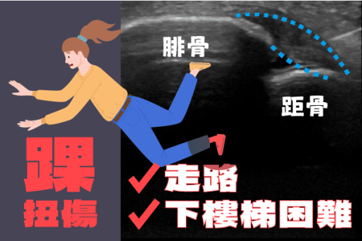 前距腓韌帶PRP注射