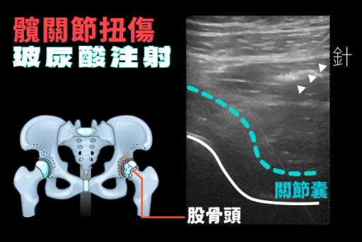 髖關節玻尿酸注射