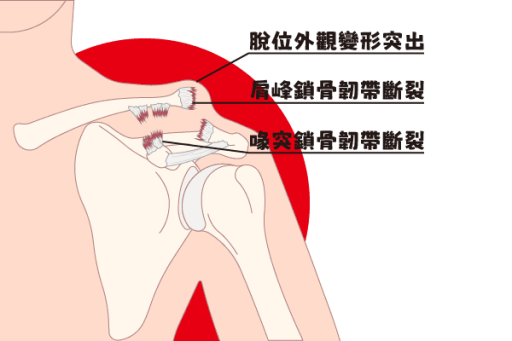 肩峰鎖骨關節損傷