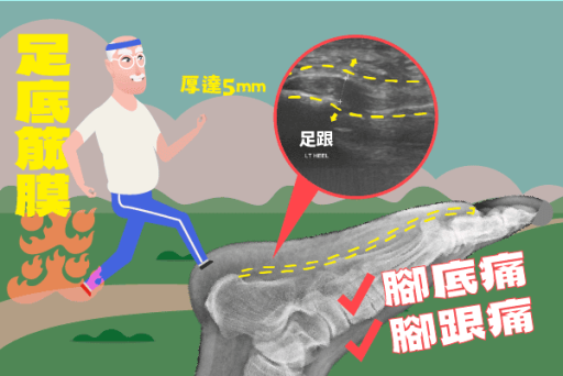 腳底痛足底筋膜炎案例