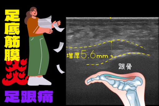 足底筋膜炎高濃度葡萄糖注射
