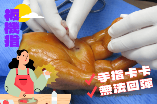 板機指微創手術