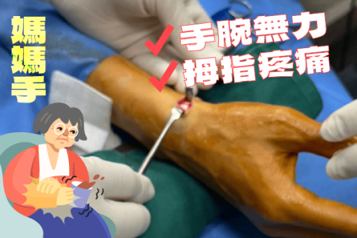 手腕痛媽媽手傳統手術