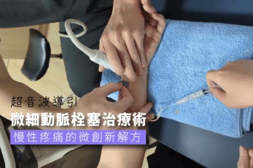 超音波導引微細動脈栓塞治療術TAME