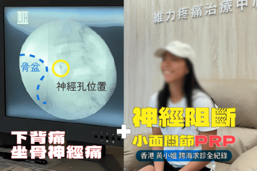 神經阻斷與小面關節PRP聯合治療