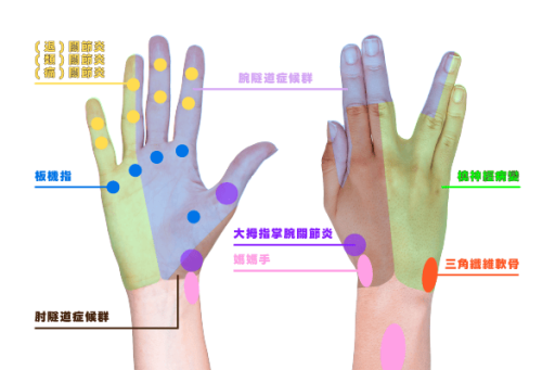 圖解手痛