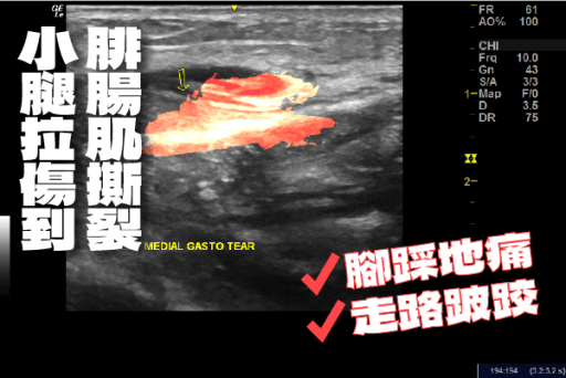 小腿拉傷到腓腸肌撕裂