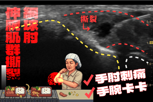 伸腕肌群撕裂網球肘PRP注射