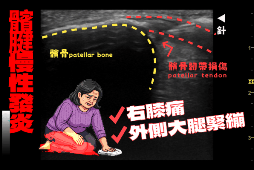 髕骨慢性肌腱炎葡萄糖注射