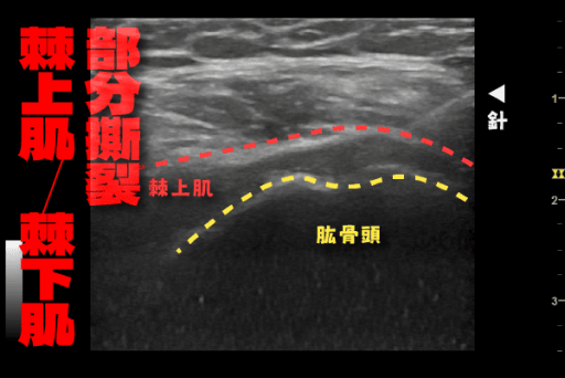 棘上肌棘下肌部分撕裂