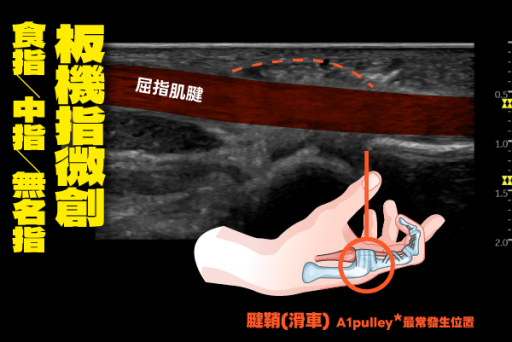 板機指微創手術案例